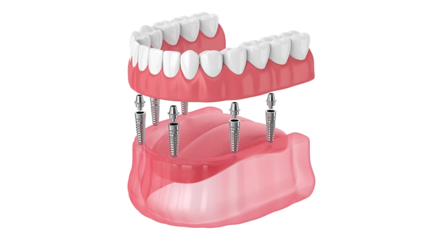 Removable full implant denture isolated over white background Royalty-Free Stock Footage #1054547423