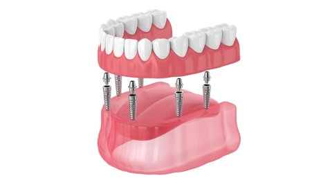 Removable full implant denture isolated over white background