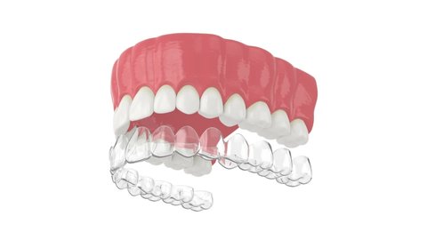 Invisalign removable and invisible retainer placement on upper jaw over white background