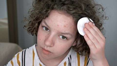Girl cleanses her face with lotion, looking in the mirror. The problem of teenage acne.