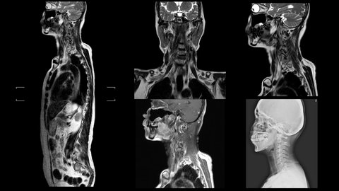 MRI scans of the cervical spine human body. Examining and identifying health problems with magnetic resonance imaging. Medical healthcare footage concept.