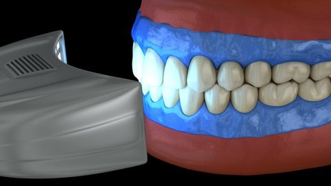 Proffesioinal teeth whitening, light-activation on tooth bleaching. 3D animation concept.
