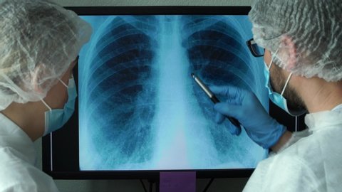 Team of doctors at computer monitor in clinic discuss x-ray of patient with lung pneumonia caused by infection. Lungs are affected by virus. COVID-19