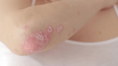Woman hands scratch acute psoriasis on the elbows, which is an autoimmune incurable dermatological skin disease.Psoriatic arthritis.Close up