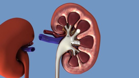 kidney stone operation imaging animation