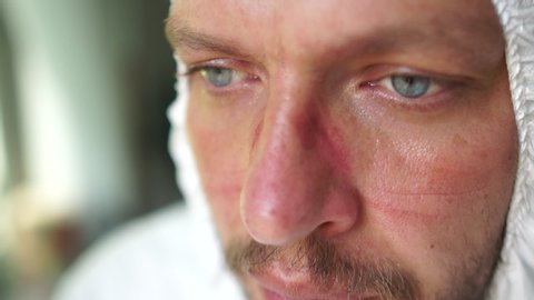 Close up portrait of a tired doctor. A young male doctor with blue eyes is resting after a work shift. Mask marks on face