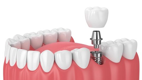 Jaw with dental implant placement over white background
