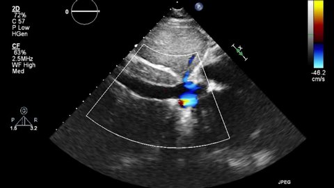 Transesophageal Ultrasound Video Doppler Mode Stock Footage Video (100% ...