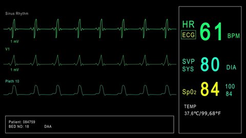 Looped: Patient monitor displays vital signs ECG electrocardiogram EKG, oxygen saturation SPO2 and respiration. Medical examination. 4K video footage animation. Cardiac monitoring. Electrocardiography