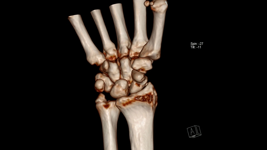 ULNAR-STYLOID-PROCESS Footage, Videos and Clips in HD and 4K - Avopix.com