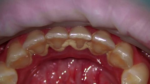 teeth tartar and plaque cleaning in dental offive