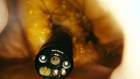 Endoscope inside the stomach. Water, mucus, and dust inside the stomach. Real image inside the stomach. Highlights and reflections. Stopping bleeding with a Clip applicator. Macro shot. 