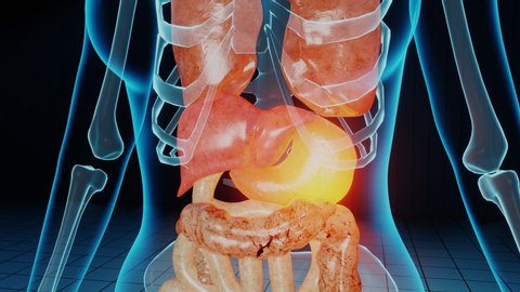 Failing and injured stomach in 3D render animation. Cancer, tumor tissue problem, metastasis and healthcare issue. Medical medicine science, human anatomy, gastrointestinal injury