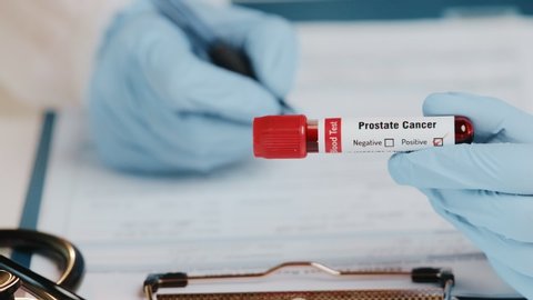 Doctor or laboratory technician holds in one hand laboratory positive blood test tube for cancer prostate, other hand writing down results to patients medical record. Laboratory medical diagnostics