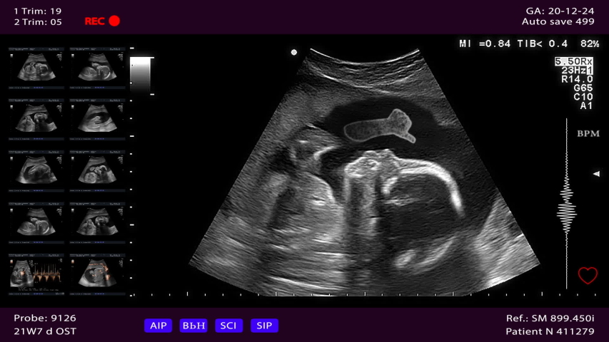Unborn baby gives thumbs up from the womb. Ultrasound scanning with heart diagnostics, child is trying to say that he is ok. Seamlessly loop conceptual footage Royalty-Free Stock Footage #1056181001