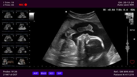Unborn baby gives thumbs up from the womb. Ultrasound scanning with heart diagnostics, child is trying to say that he is ok. Seamlessly loop conceptual footage
