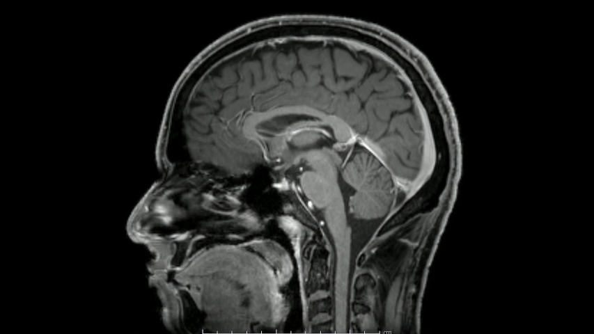 Magnetic resonance  images of the brain (MRI brain) sagittal post contrast sequence in cine mode showing normal anatomy Royalty-Free Stock Footage #1056241145