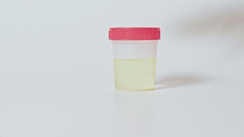 Urine test. Clinical diagnostics. Technician hand in glove sample bottle with yellow liquid isolated on white set of 3.