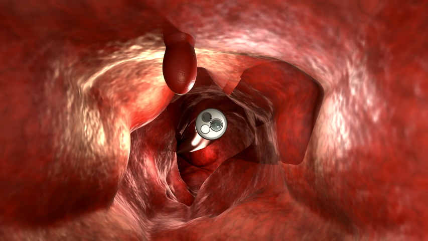 3d rendering endoscope with colonic polyp in intestine 4k footage | Shutterstock HD Video #1056457925