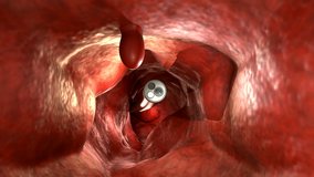 3d rendering endoscope with colonic polyp in intestine 4k footage