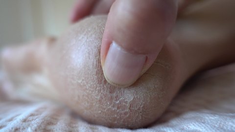 4K Close up a finger is rubbing cracked heel of female sole
