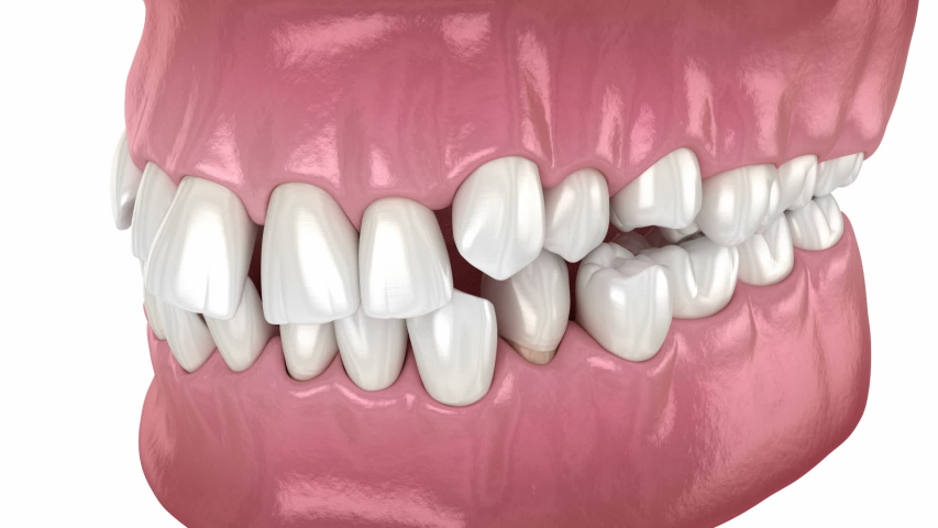 Abnormal teeth position, correction process. Medically accurate dental 3D animation | Shutterstock HD Video #1056525461