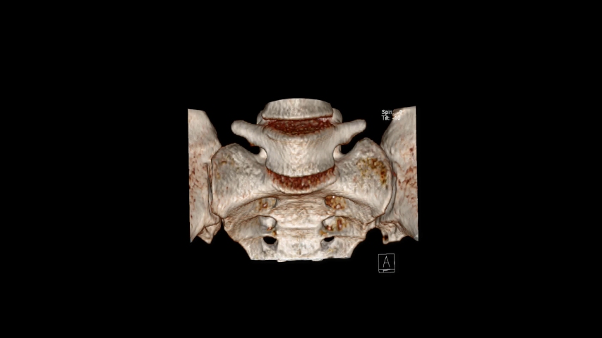 CT-SACROILIAC-JOINTS Footage, Videos and Clips in HD and 4K - Avopix.com