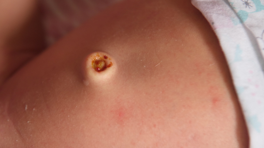 is it safe to put peroxide in your belly button