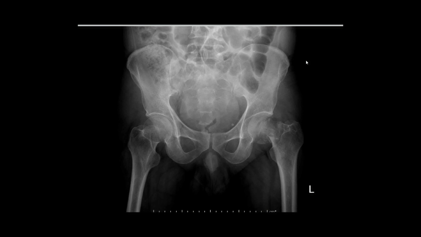 Femur Bone Fracture XRAY. Таз футаж. Bones ray