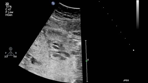 Ultrasound examination of the fetal heart.