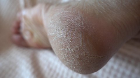 4K Close up Viewing cracks on the heel of female sole, handhold

