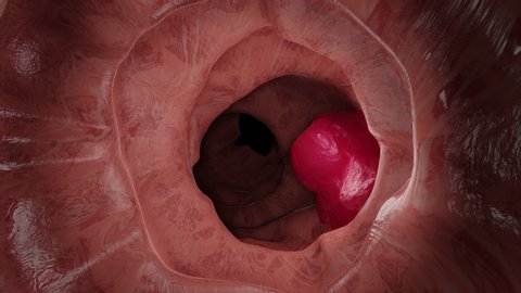 3D Animation of the colon during a enteroscopy with a intestinal or bowel cancer tumor visible.