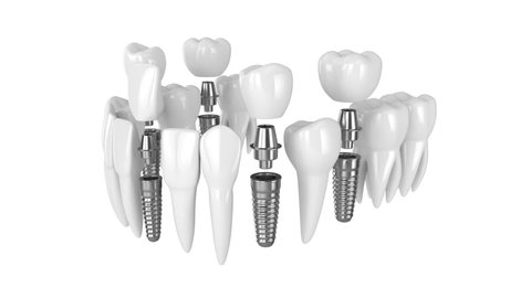 Toothing with dental implants over white background