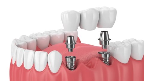 Jaw with implants supporting dental bridge over white background