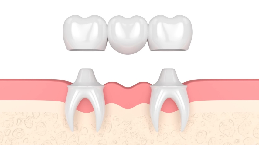 Gums with dental molar bridge over white | Shutterstock HD Video #1056865220