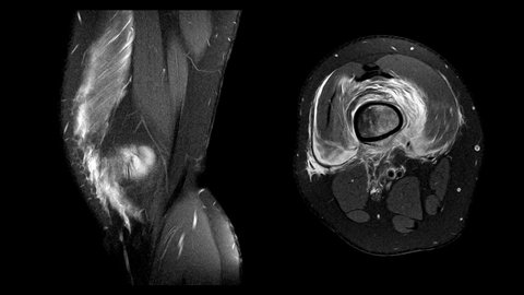 MRI OF RIGHT KNEE HISTORY: A 15-year-old woman presented with pathological fracture of right femur
Suggestive of malignant bone tumor
could be either osteosarcoma or Ewing sarcoma.Medical footage.