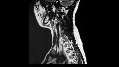 MRI, magnetic resonance imaging, of the cervical spine (neck), demonstrating arthritic and degenerative changes with slipped discs or disc protrusion onto the spinal cord.