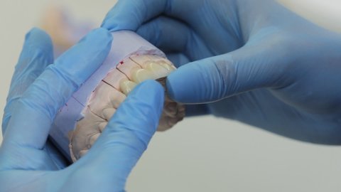 Close-up of a dental model in hands of the dentist. Veneer. Dental crown. Prosthesis. The dentist advises the patient and shows Orthodontics model