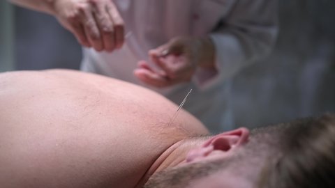 Acupuncture procedure. The doctor sticks needles in the man's back. Traditional Chinese Medicine. 4K