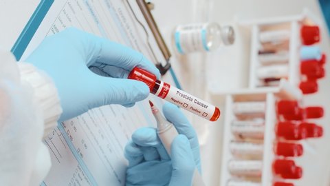 Vertical footage of laboratory technician holds in one hand laboratory positive blood test tube for cancer prostate and writing down results to patients medical record. Laboratory medical diagnostics