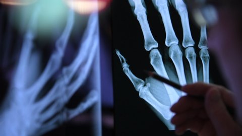 CU R/F Doctor examining scan of hand for damage and disease / High Wycombe, Bucks, UK