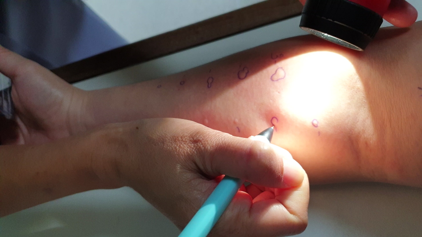 Medical skin prick test for allergy aerosol testing rash reaction