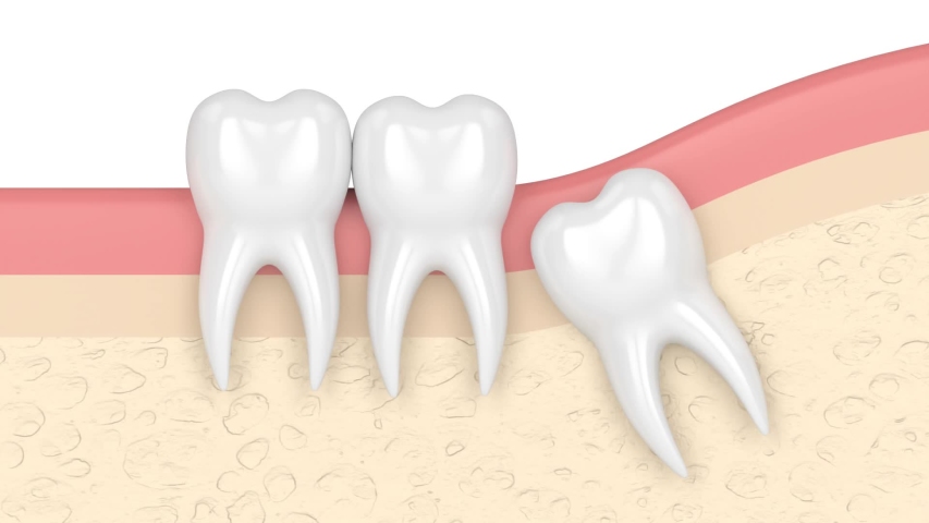 Gums with wisdom tooth mesial causing crowding
 | Shutterstock HD Video #1057848169