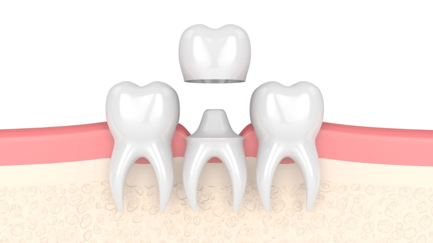 Gums with dental composite crown filling | Shutterstock HD Video #1057848310