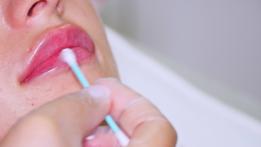 close-up, female lips. Hand, in medical glove, applies soothing lip balm to the lips with a cotton swab after lip augmentation procedure with hyaluronic acid injections. Royalty-Free Stock Footage #1057864162