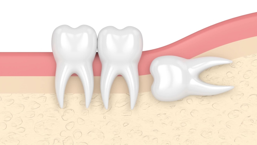 Teeth in gums with wisdom tooth horizontal impaction | Shutterstock HD Video #1057866787