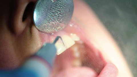 Close up shot of professional scaling teeth. Dentistry practice. Dental hygiene