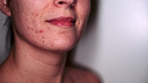 Problematic Skin - Portrait of Young Woman who suffers severe acne - Macro - Turns Head and smiles nervously. 4K