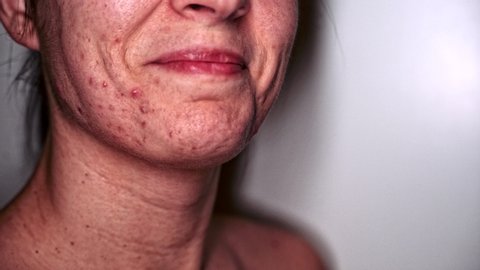 Skin problem - Young Woman who suffers severe acne - Macro - At the end of the video, she turns her head.