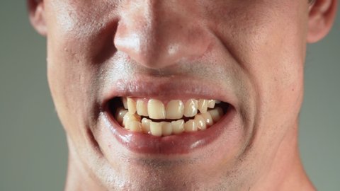 The man shows his yellow crooked and protruding teeth. Malocclusion. Close-up.